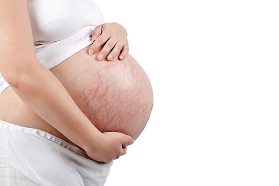 Wann schwangerschaftsstreifen ab Schwangerschaftsstreifen vorbeugen